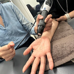 Radial shockwave therapy being applied to a patient’s palm and wrist for carpal tunnel syndrome treatment.