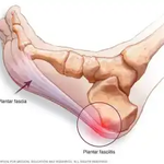 Medical illustration of plantar fasciitis showing heel spur and inflammation at the plantar fascia.