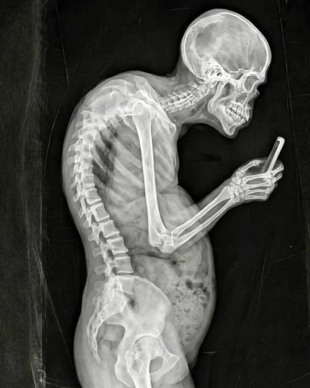 Illustration of forward head posture from phone use showing spinal stress, tech neck, and posture-related neck and back strain.