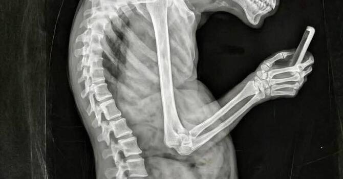 How Screen Time Affects Spinal Health | Tech Neck Care in Huntsville | Spine Align Chiropractic & Wellness