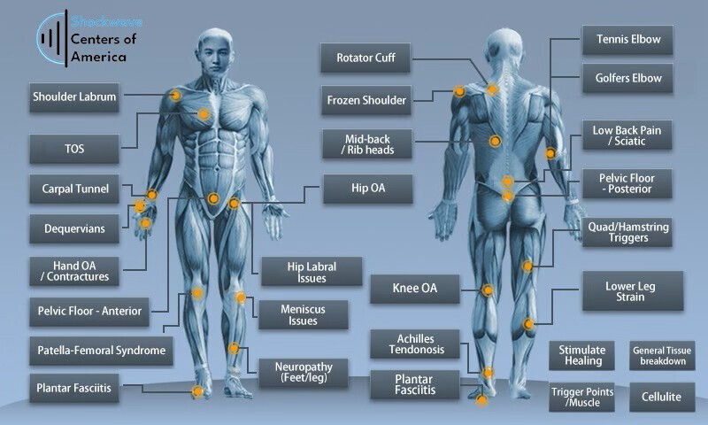 Shockwave therapy treatment areas showing common conditions including plantar fasciitis, knee pain, hip pain, shoulder injuries, and neuropathy