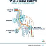 Pinched nerve pathway with possible causes of the nerve pinch