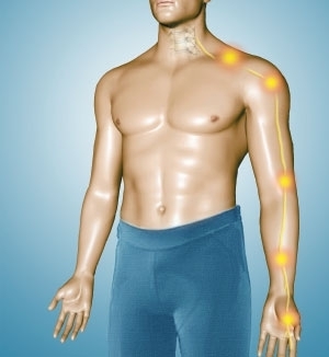 Pinched nerve in the neck causing shoulder blade pain, arm pain, and hand numbness