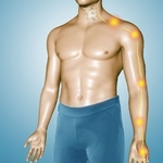 Pinched nerve in the neck causing shoulder blade pain, arm pain, and hand numbness